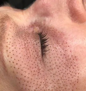Después de tratamiento de fibroblast
