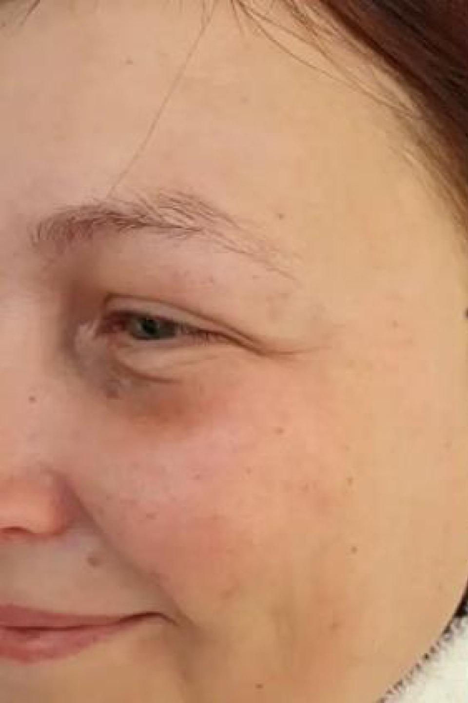 Antes y después de tratamiento facial