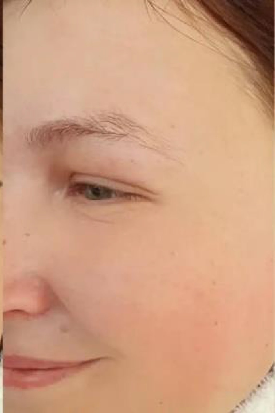 Antes y después de tratamiento facial
