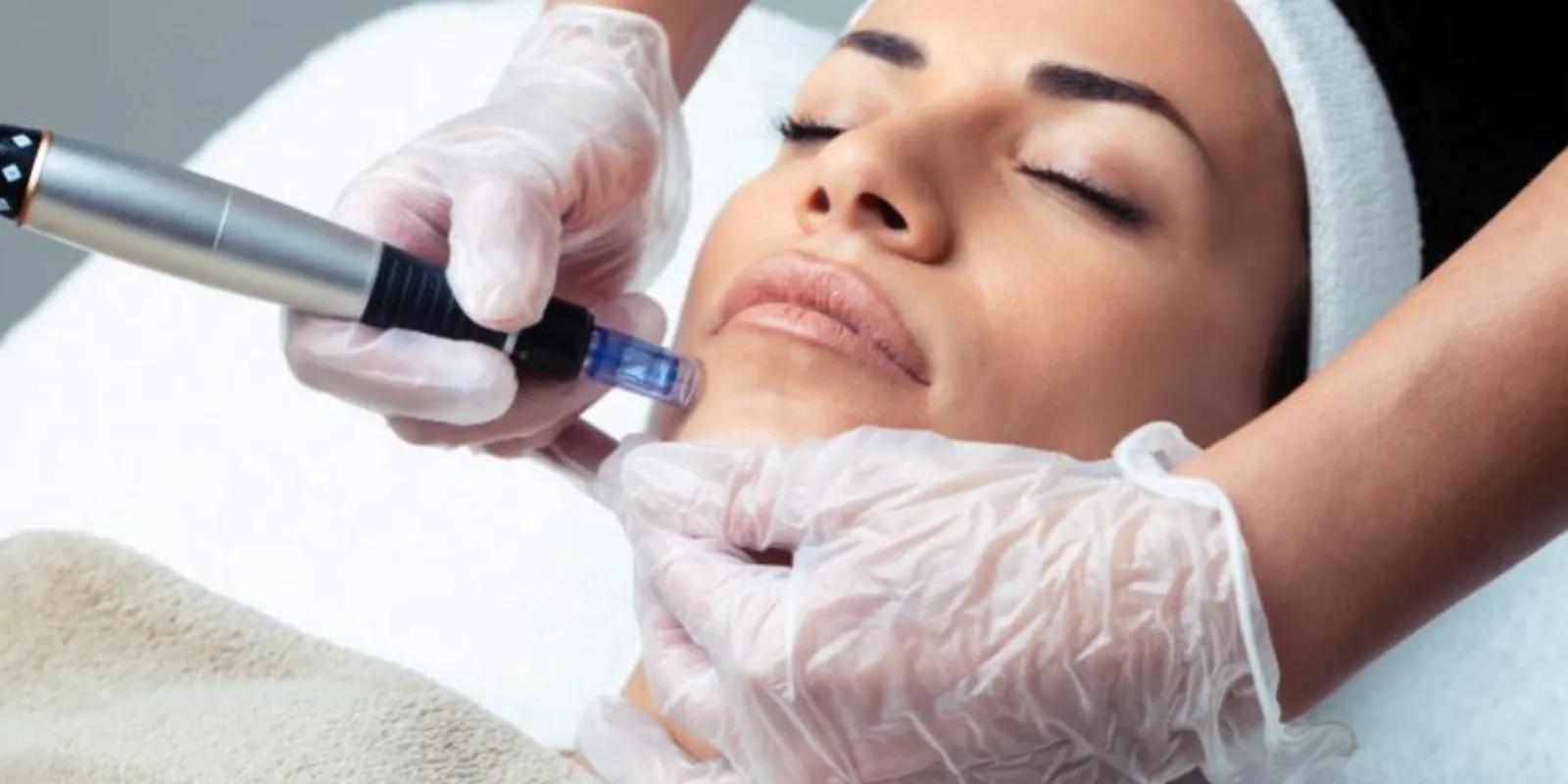 Tratamiento de microneedling facial