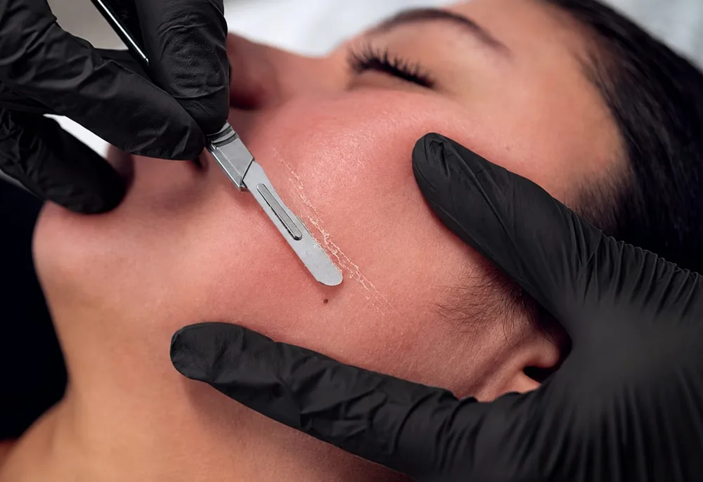 Dermaplaning