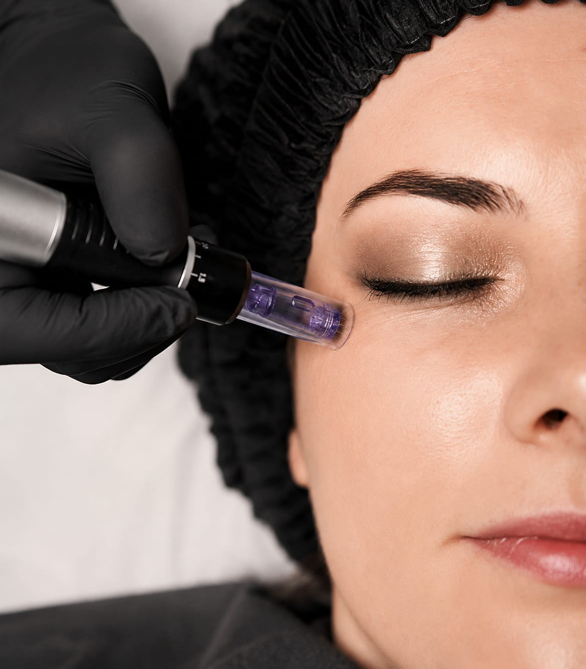 Microneedling